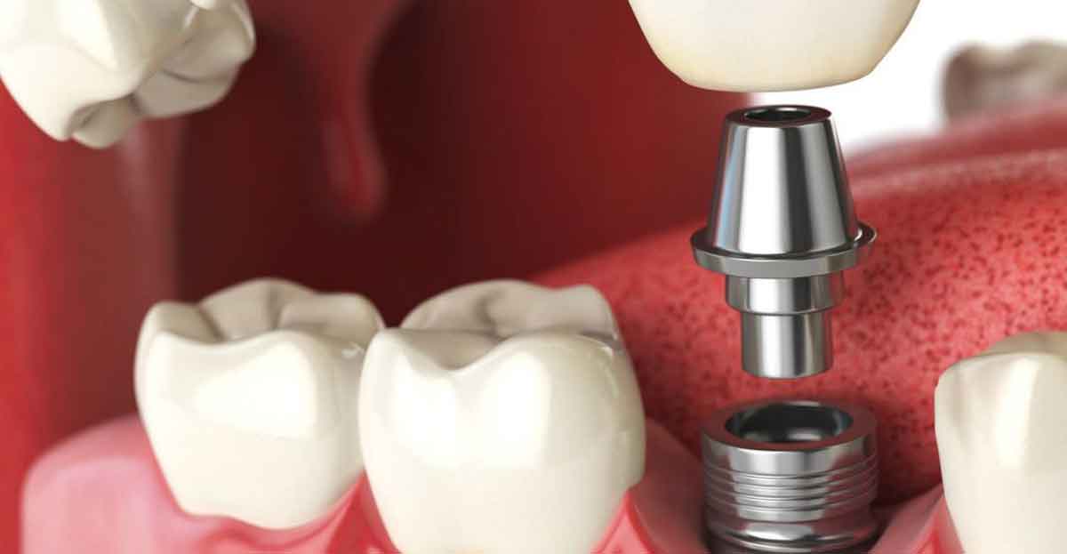 Dónde van los implantes dentales, prótesis, placas de acero o tornillos metálicos de un difunto tras su incineración