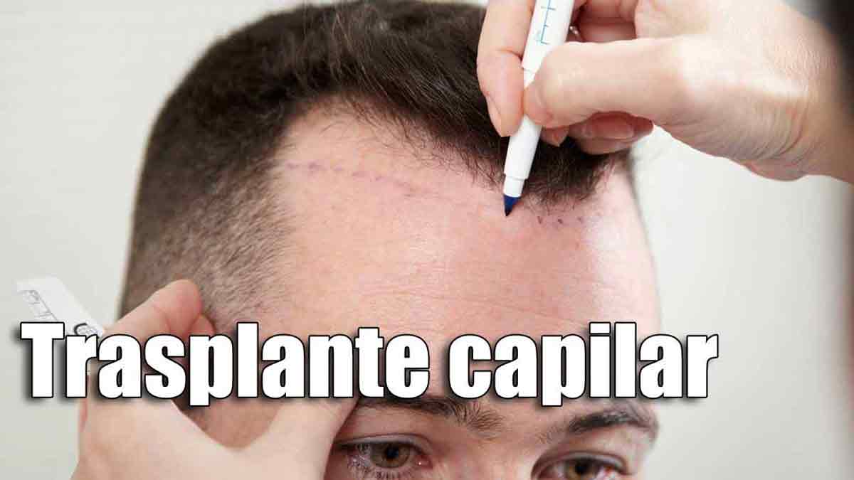 Trasplante capilar, precios y tratamientos