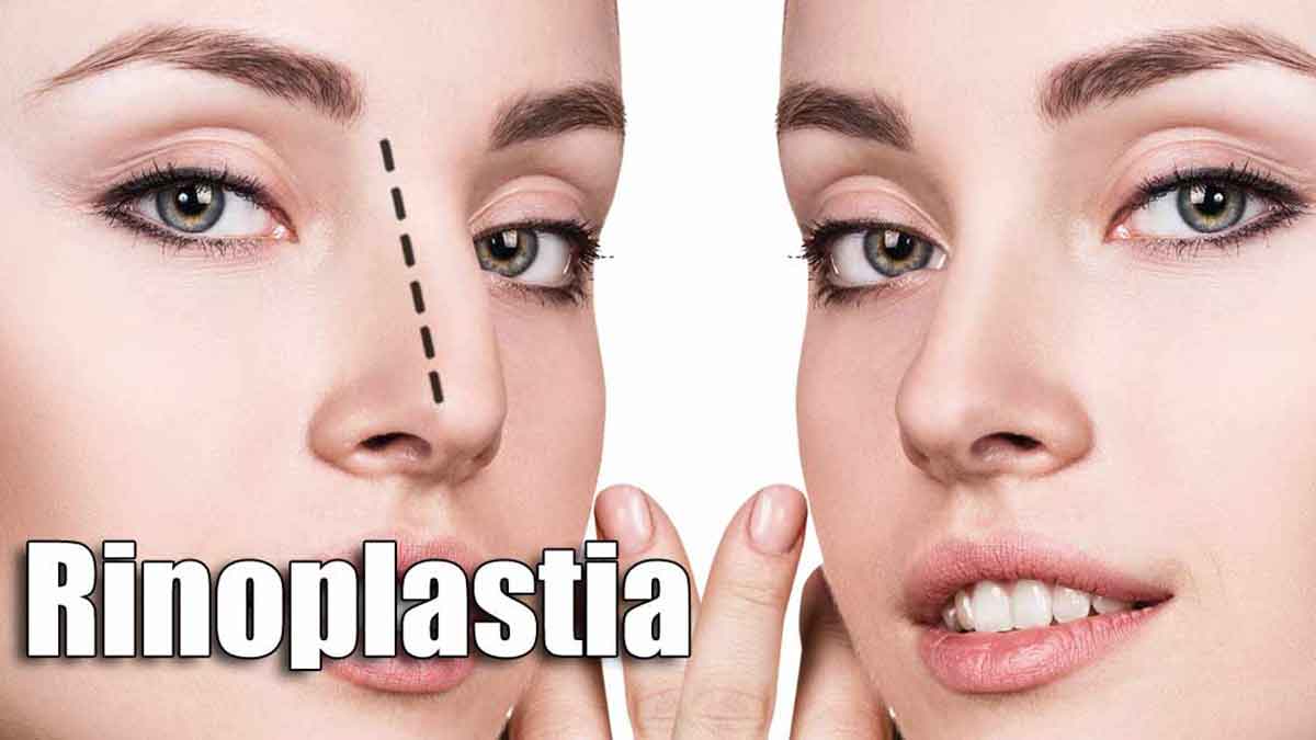 Cuánto cuesta una rinoplastia: tipos y recuperación