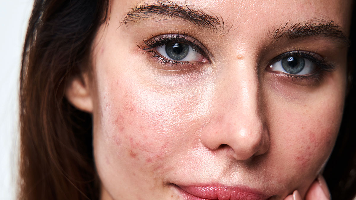 How to Remove Acne Scars and Spots from Face
